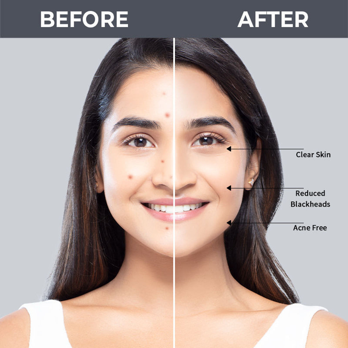 Nykaa SKINRX 2% Salicylic Acid Face Serum For Acne, Blackheads, Whiteheads & Clear Skin