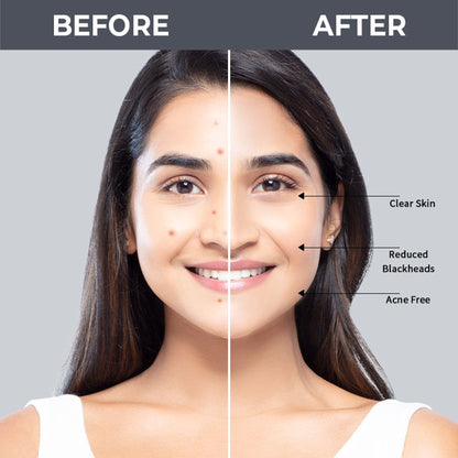 Nykaa SKINRX 2% Salicylic Acid Face Serum For Acne, Blackheads, Whiteheads & Clear Skin