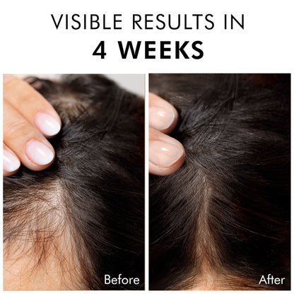 MCaffeine Advanced Hair Growth 20% Caffexil® Hair Serum With Keratin & Rosemary For 80% Hair Growth