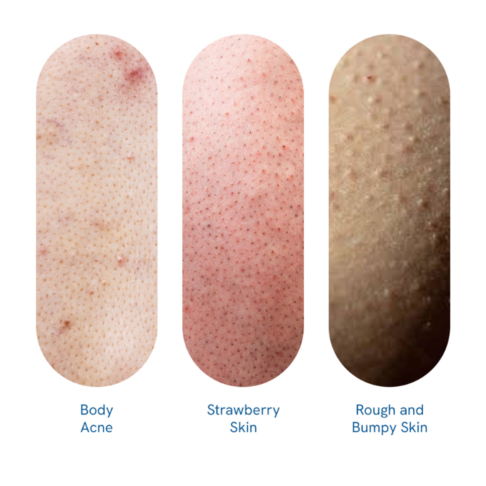 Be Bodywise 1% Salicylic Acid Body Wash, Treats Body Acne & Strawberry Skin - Exfoliating Shower Gel