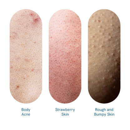 Be Bodywise 1% Salicylic Acid Body Wash, Treats Body Acne & Strawberry Skin - Exfoliating Shower Gel