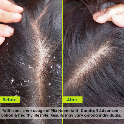 Plix Neem Anti-Dandruff Advanced Lotion
