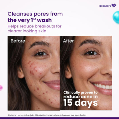 Venusia Acne Facewash With Sebum Control & Hydrating Formula