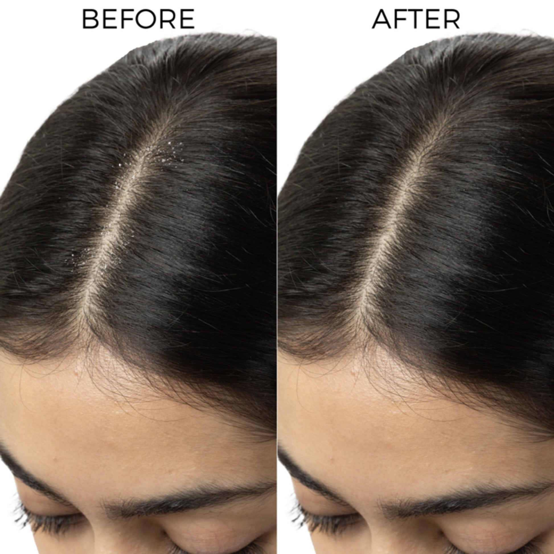 Brillare 5% Tea Tree Hair Oil Shots for Dandruff & Itchy Scalp, with 1% Salicylic Acid