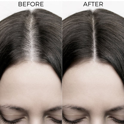 Brillare 40% Onion Oil shots for Hair Fall Reduction Visible Hair Fall Reduction in 15 Days