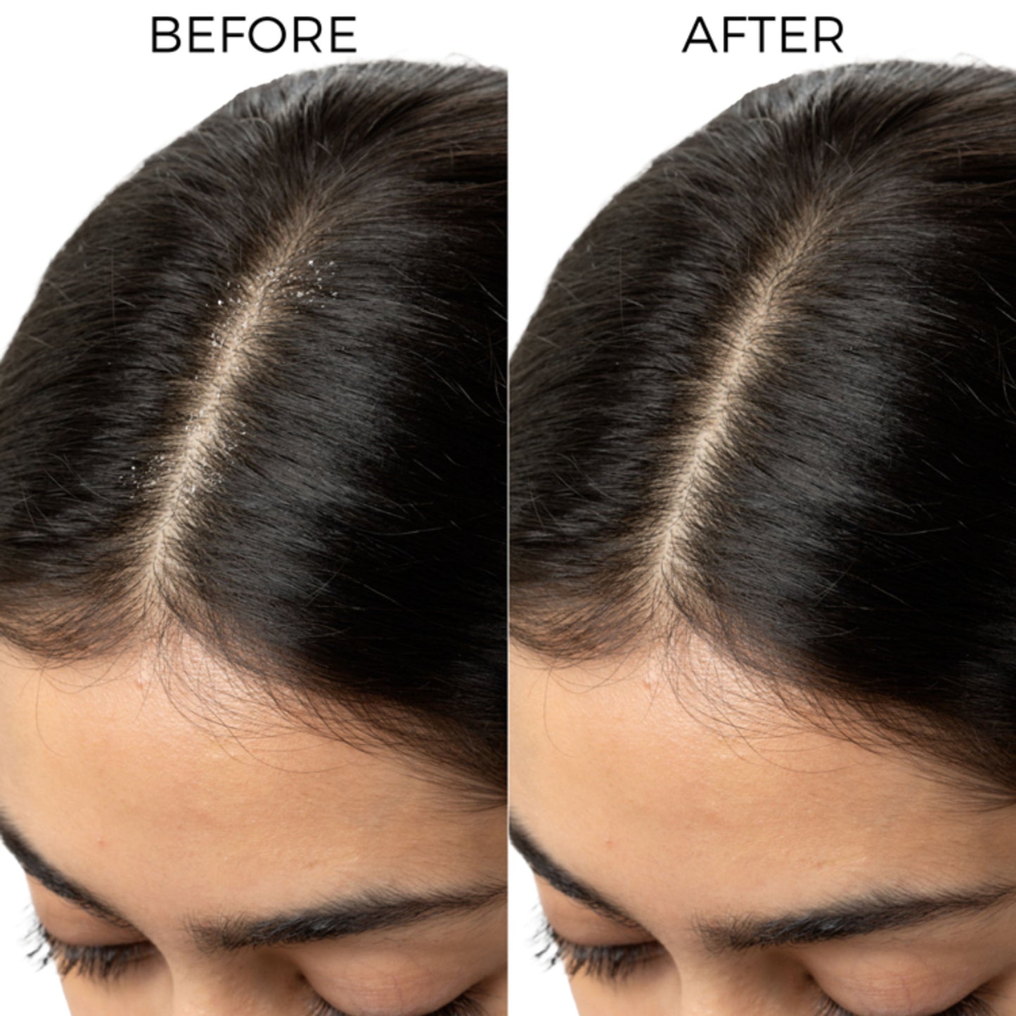 Brillare Lactylate Anti-Dandruff Shampoo Soothes Itchy Scalp & Reduces Dandruff