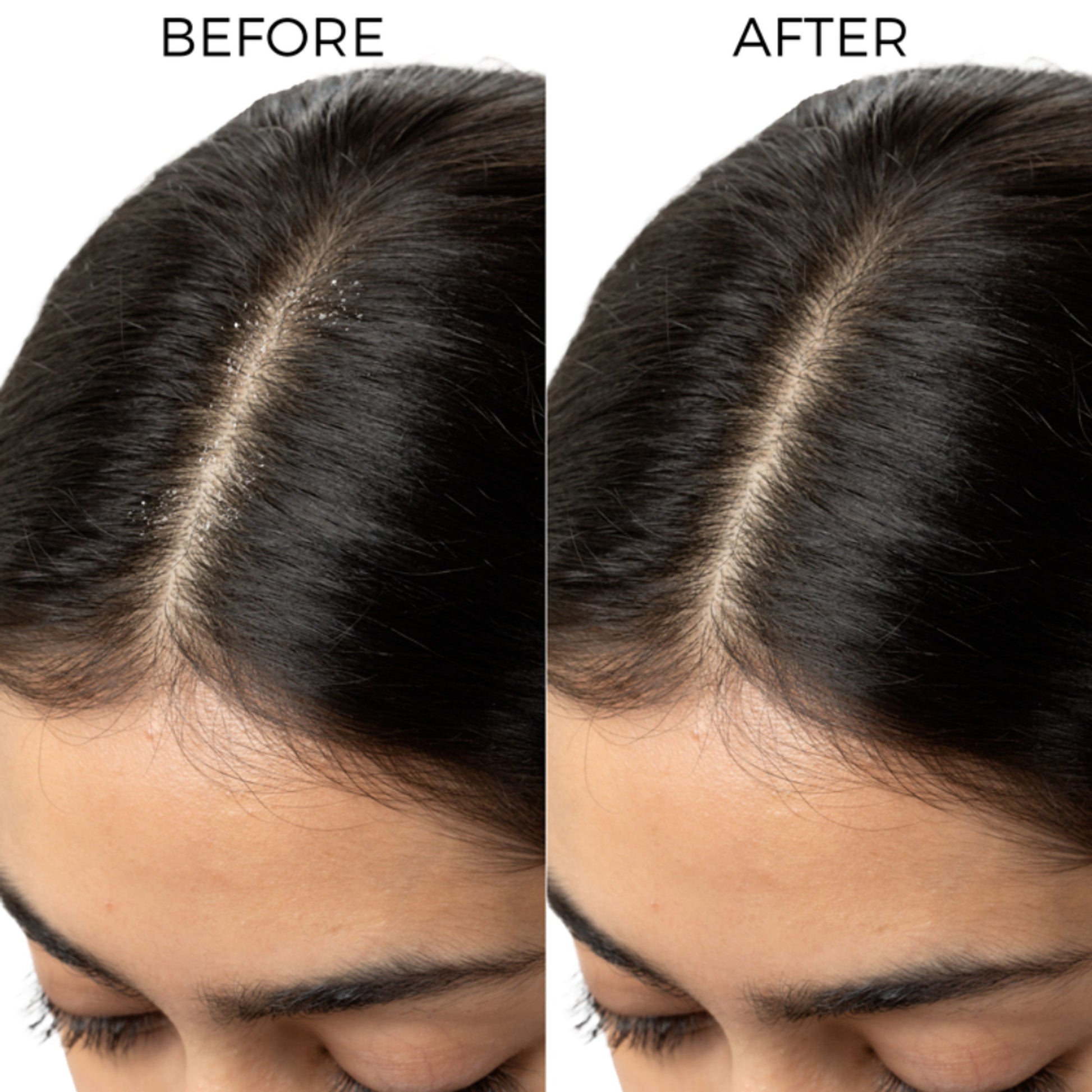 Brillare Lactylate Anti-Dandruff Shampoo Soothes Itchy Scalp & Reduces Dandruff