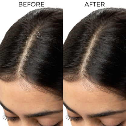 Brillare Lactylate Anti-Dandruff Shampoo Soothes Itchy Scalp & Reduces Dandruff