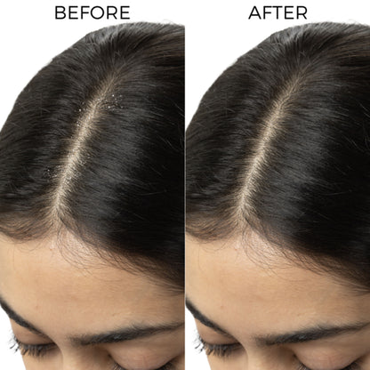 Brillare Lactylate Anti-Dandruff Serum for Hair & Scalp | Clears Dandruff, Itch & Flakes