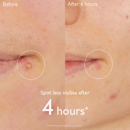Caudalie Vinopure Salicylic Spot Solution