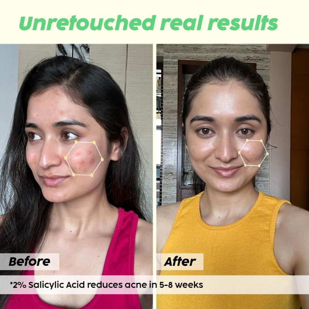 Plix 2% Salicylic Acid Acne Spot Corrector Gel For Reducing Active Acne, Controls Oil and Acne Scars