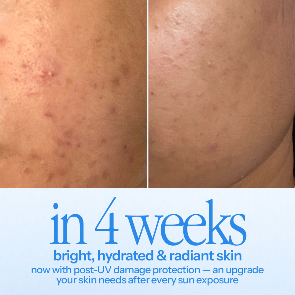 d'you Hustle Serum with 5% niacinamide, hyaluronic acid, and vitamin C for acne and pigmentation treatment.