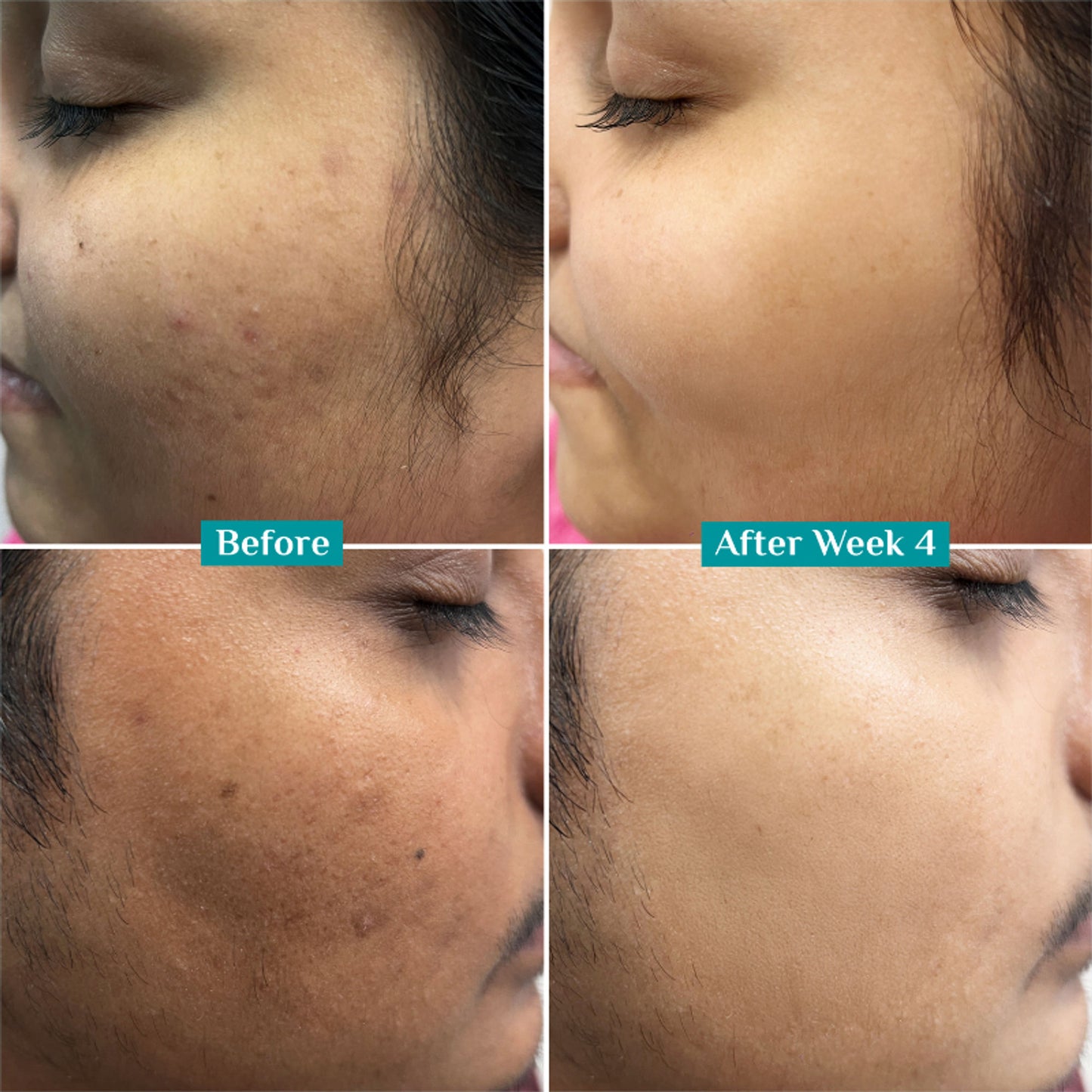 Pilgrim 10% Niacinamide with Kojic Acid & Korean Rice Water Face Serum For Clear Glass Skin Glow