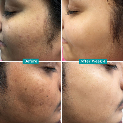 Pilgrim 10% Niacinamide with Kojic Acid & Korean Rice Water Face Serum For Clear Glass Skin Glow