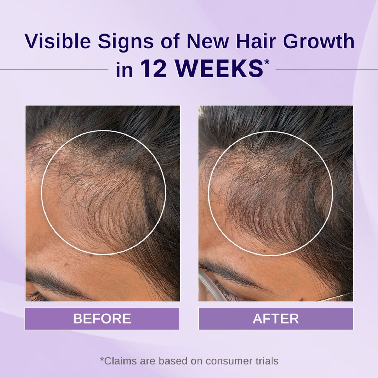 Bare Anatomy Rosemary Hibiscus Hair Growth Oil | Nourishes, Strengthens & Controls Hair Fall