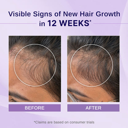 Bare Anatomy Rosemary Hibiscus Hair Growth Oil | Nourishes, Strengthens & Controls Hair Fall