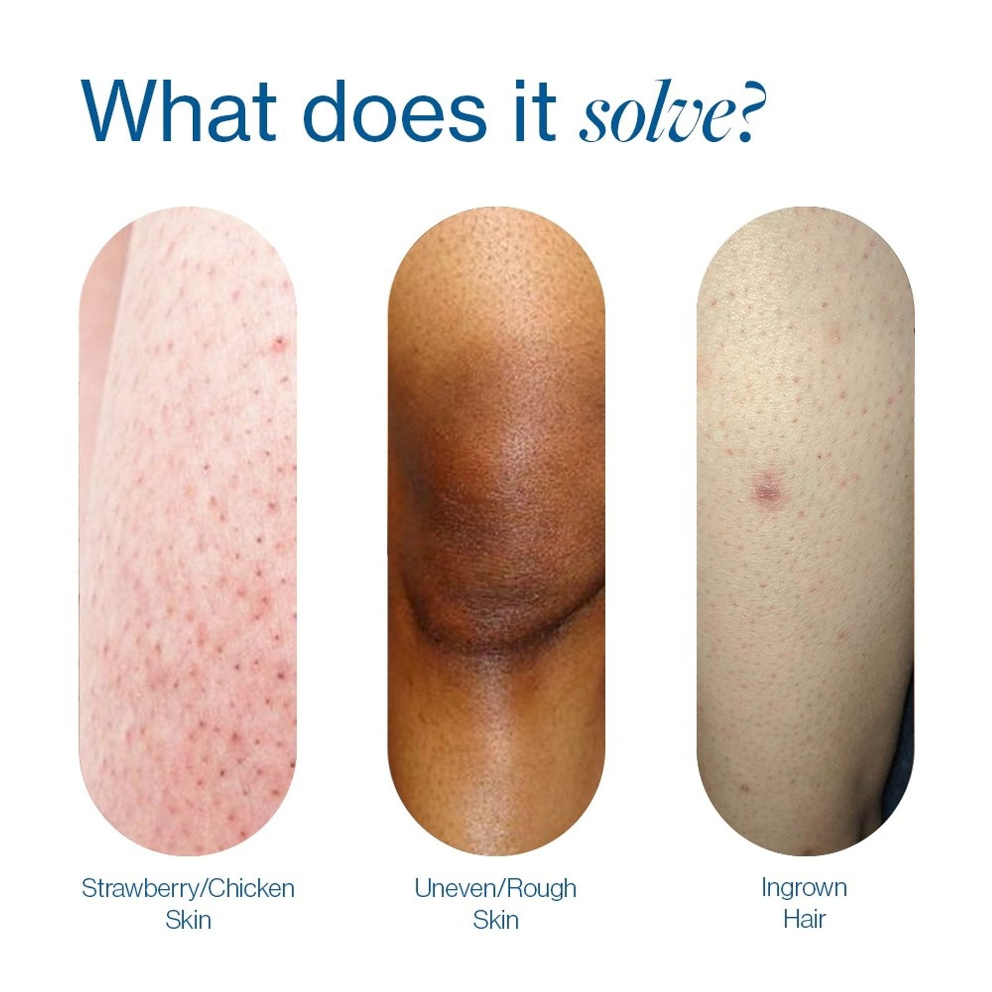 Be Bodywise 7% Glycolic Acid Stick Body Exfoliation For Smooth, Clear & Even Skin
