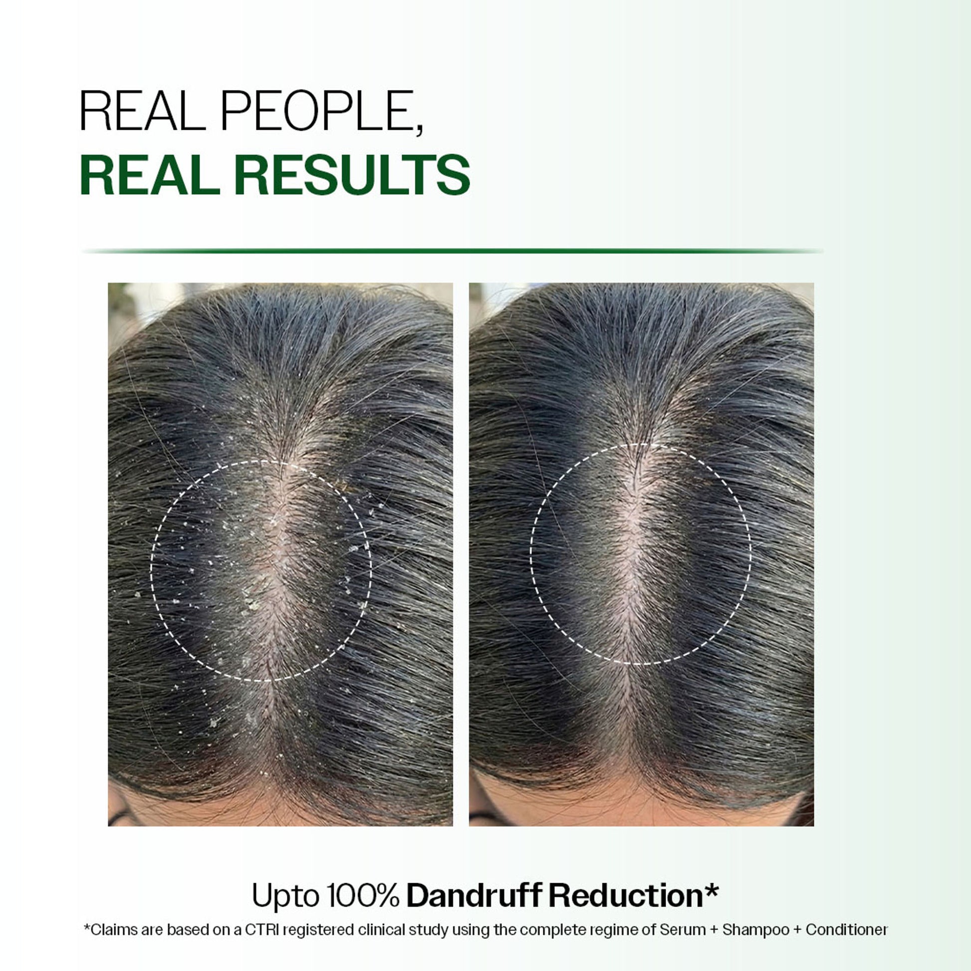 Bare Anatomy Advanced Anti Dandruff Serum Up to 100% Dandruff Reduction Non-Greasy Formula