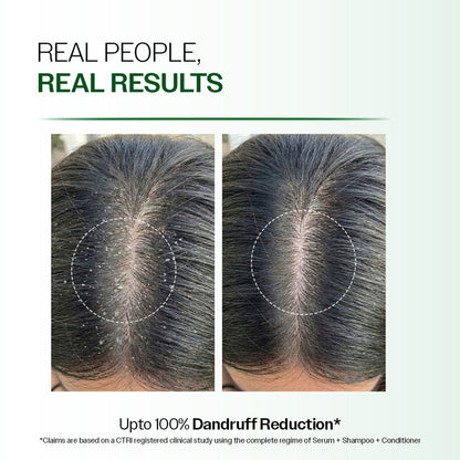 Bare Anatomy Advanced Anti Dandruff Serum Up to 100% Dandruff Reduction Non-Greasy Formula