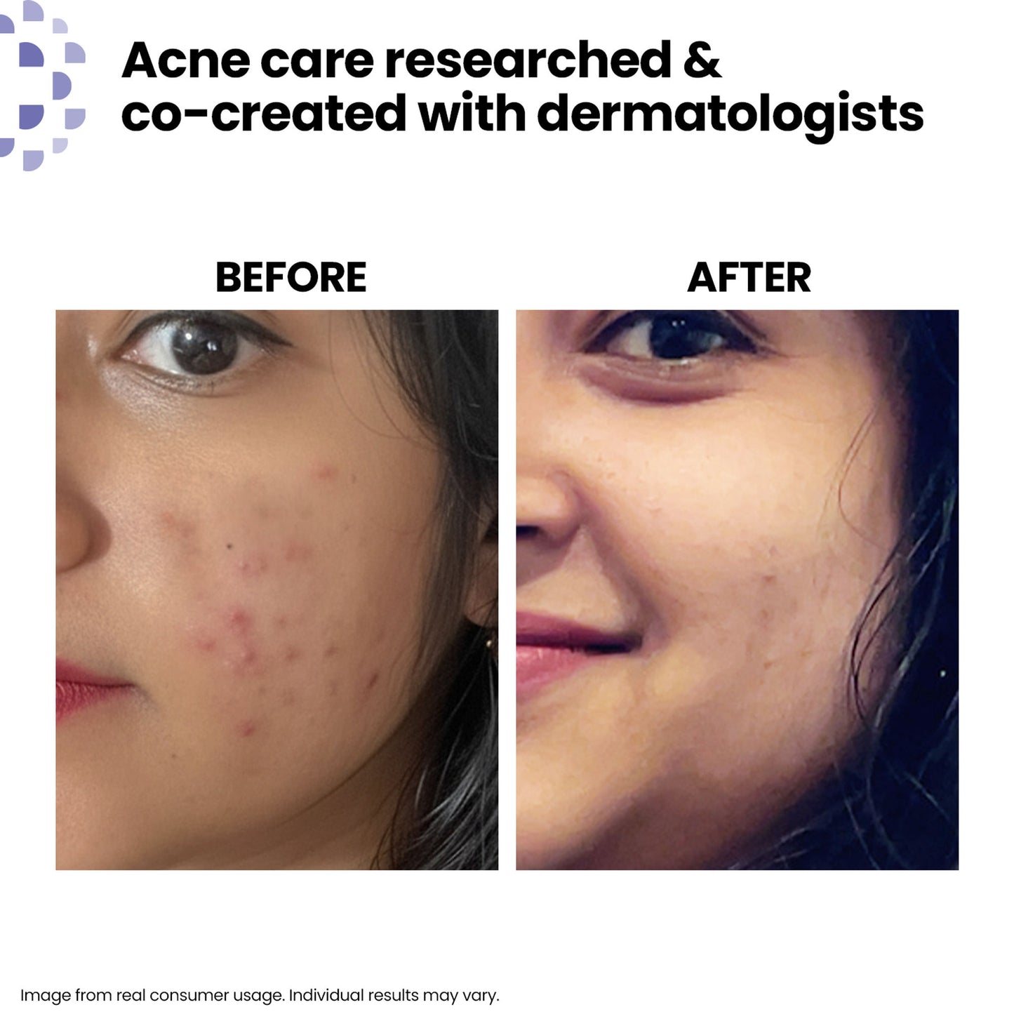 Kaya Acne Care Purifying Cleanser Salicylic Acid Face Wash Reduces Acne & Pimples for Pimple Prone Skin Face Wash for Oily Skin, 100ml