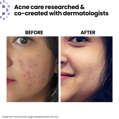Kaya Acne Care Purifying Cleanser Salicylic Acid Face Wash Reduces Acne & Pimples for Pimple Prone Skin Face Wash for Oily Skin, 100ml