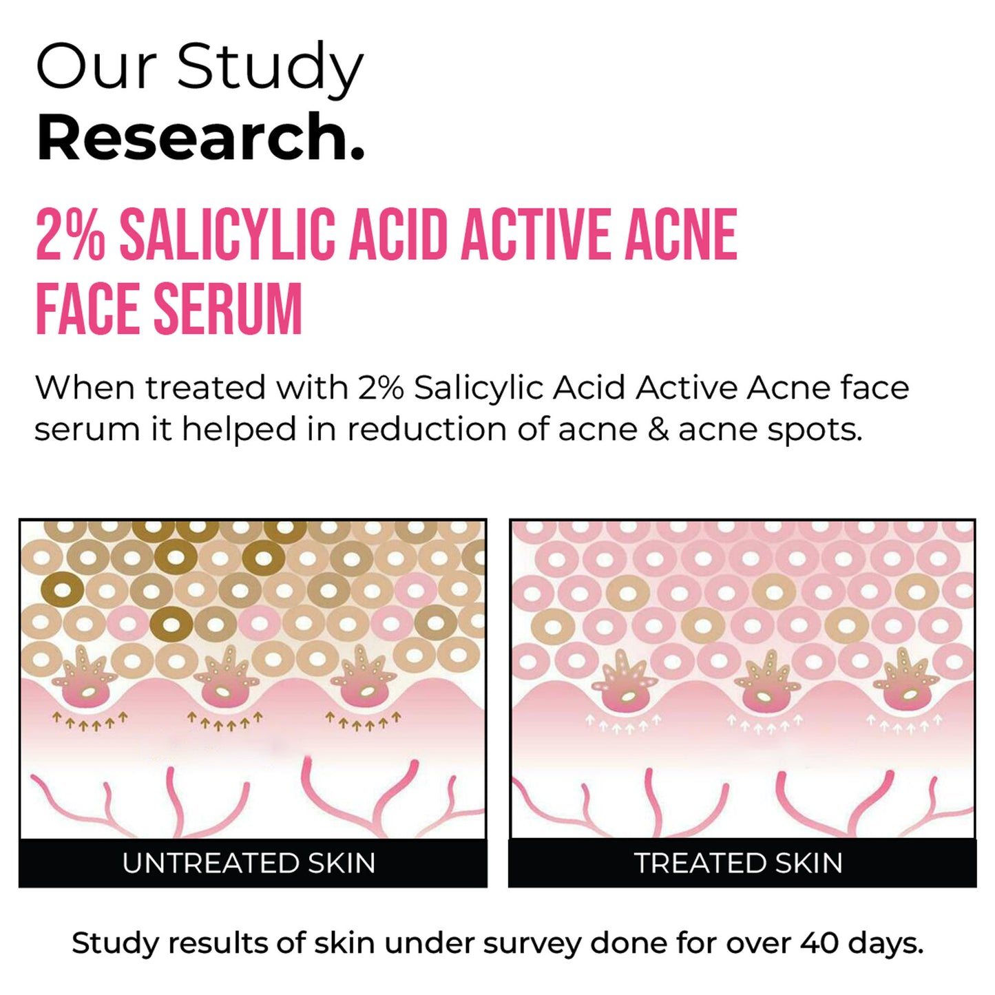 Insight Cosmetics 2% Salicylic Acid Active Acne Face Serum