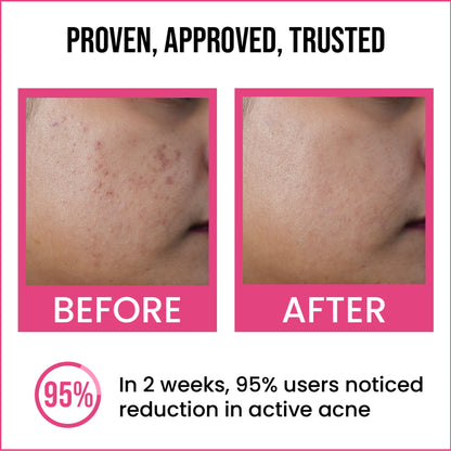Insight Cosmetics 2% Salicylic Acid Active Acne Face Serum