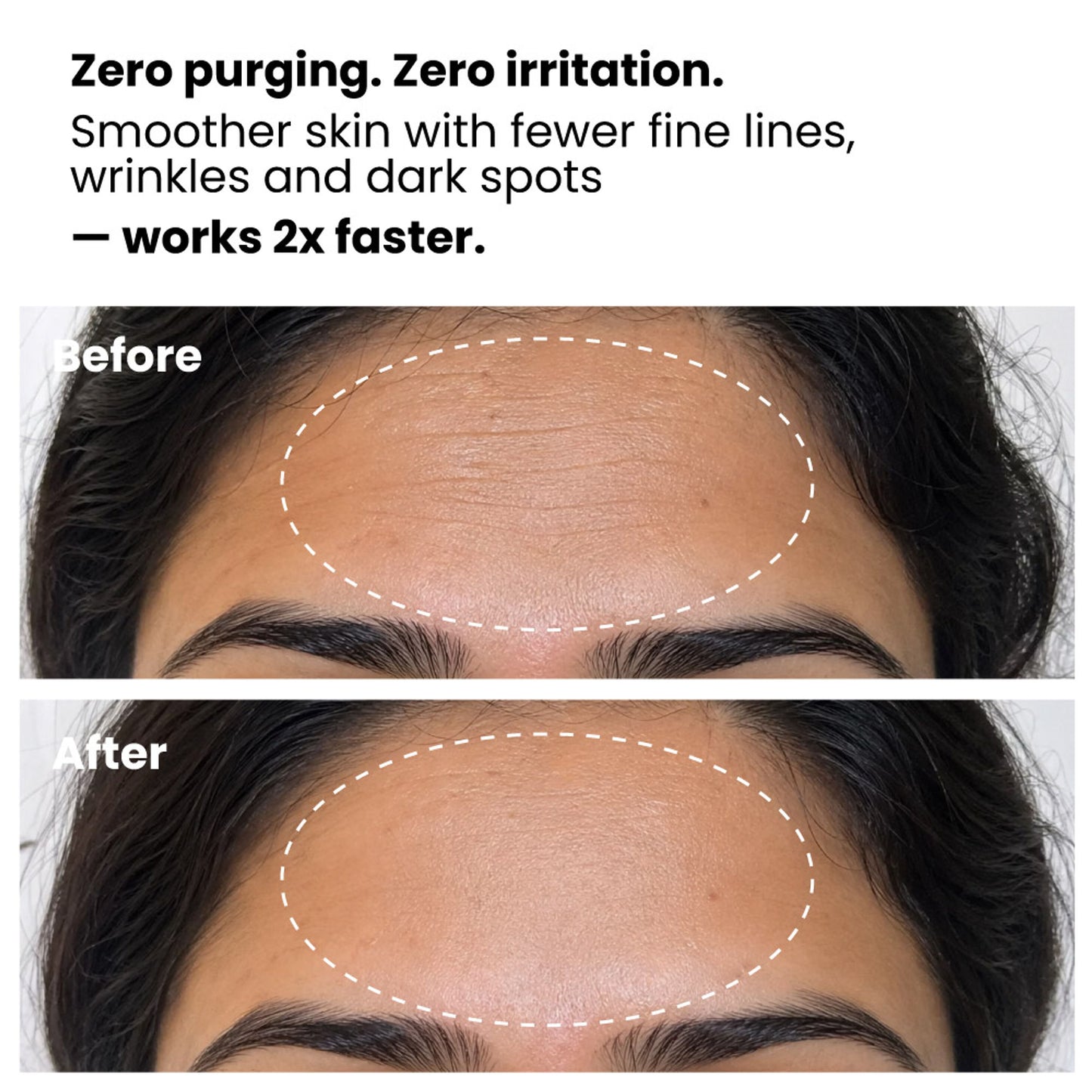 Foxtale 0.15% Anti Ageing Retinol Face Serum, Beginner-Safe, Targets Fine Lines & Wrinkles