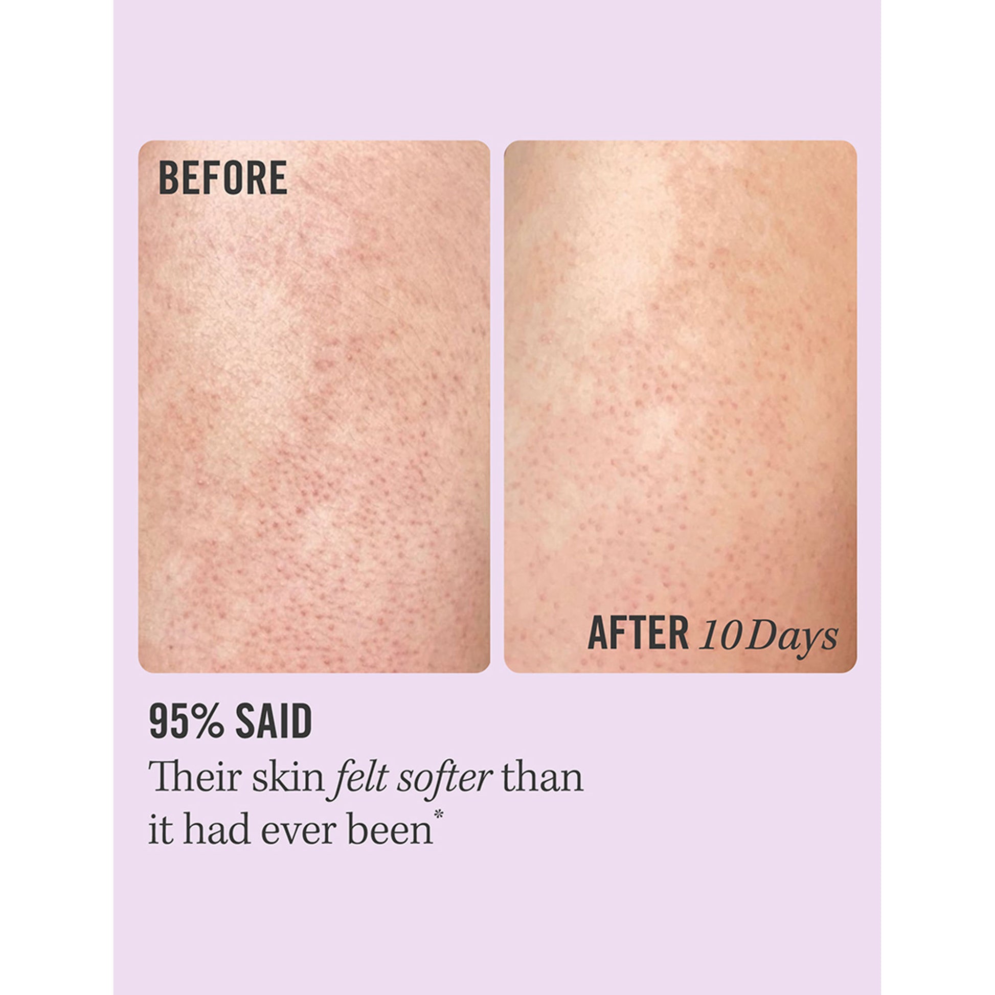 First Aid Beauty KP Bump Eraser Body Scrub With 10% AHA