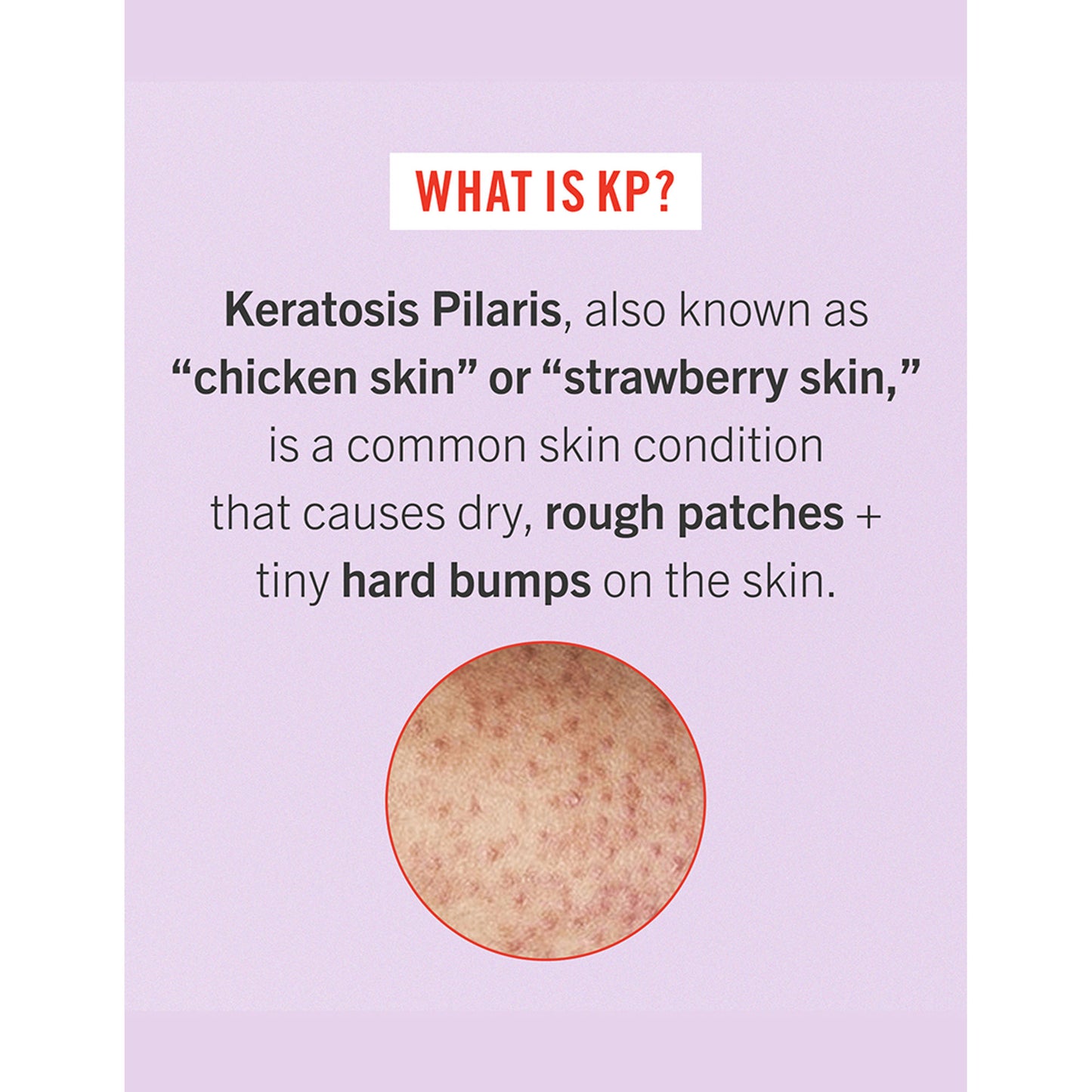 First Aid Beauty KP Bump Eraser Body Scrub With 10% AHA