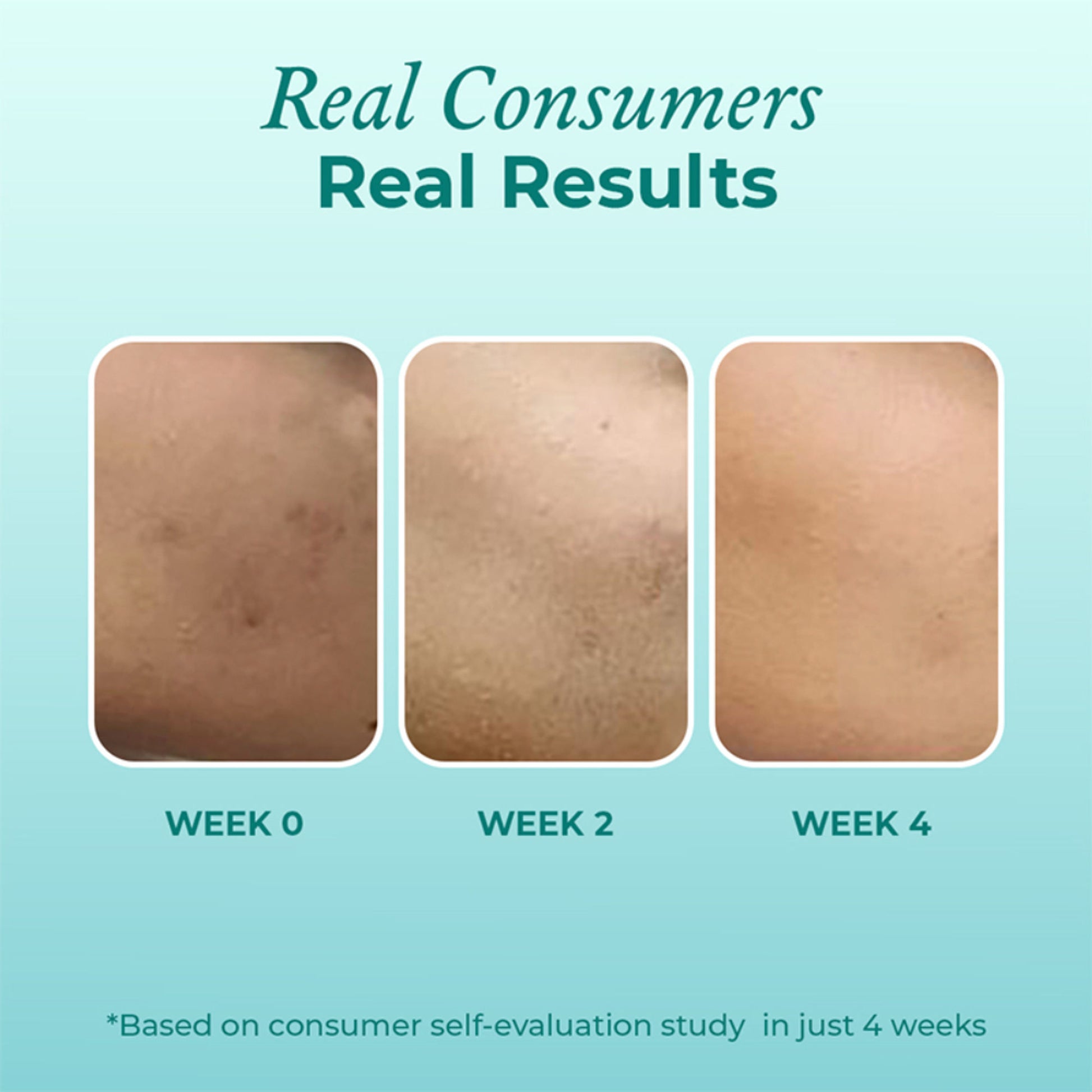 The Pink Foundry 12% Niacinamide Serum - Evens Skin Texture, Controls Excess Oil & Refines Pores