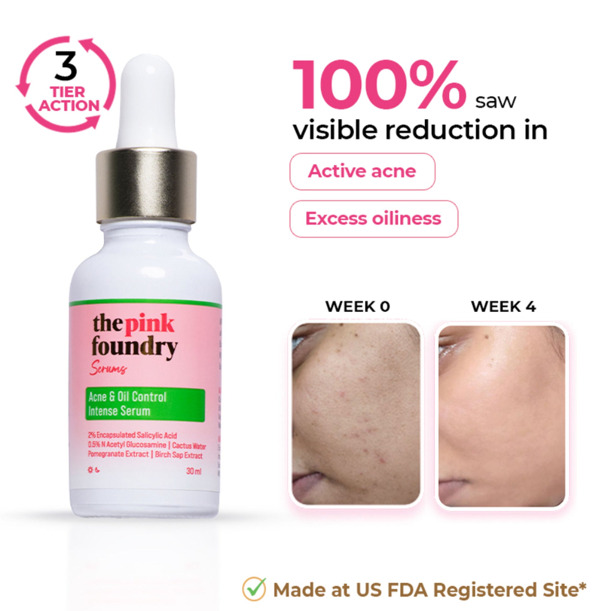 The Pink Foundry Acne & Oil Control Intense Face Serum with 2% Salicylic Acid