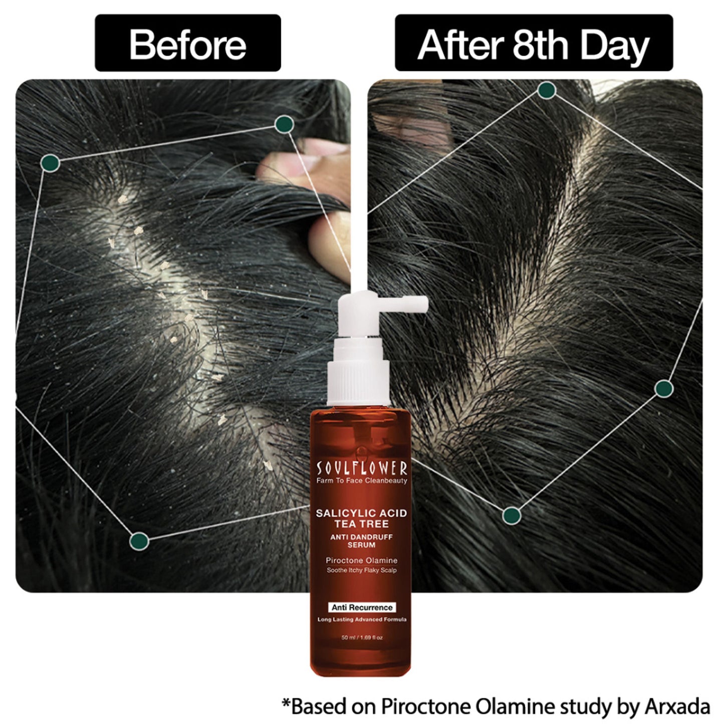 Soulflower Anti Dandruff Hair Serum with Salicylic acid, Tea Tree, Controls Dandruff, Reduce Itching
