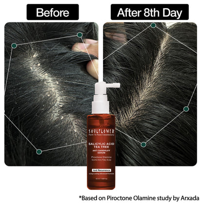 Soulflower Anti Dandruff Hair Serum with Salicylic acid, Tea Tree, Controls Dandruff, Reduce Itching