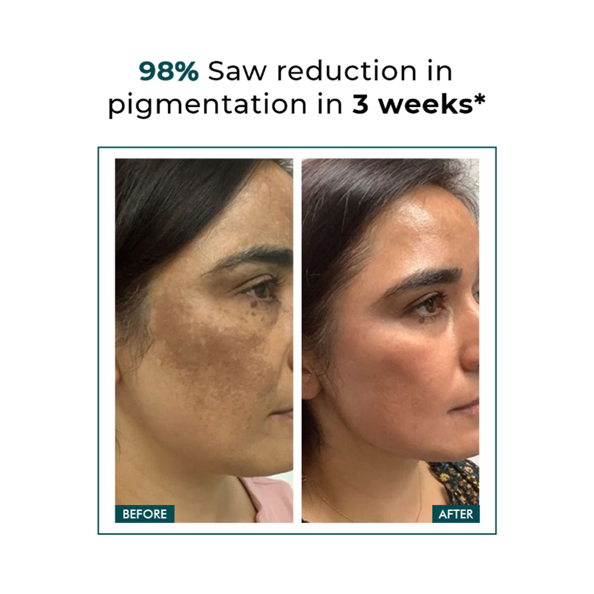 Conscious Chemist Trubiom 5% Niacinamide Serum with 1% Zinc for acne scars and uneven skin texture, featuring the serum bottle.