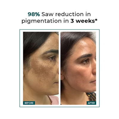 Conscious Chemist Trubiom 5% Niacinamide Serum + 1% Zinc Improves Acne Scar & Uneven Skin Texture