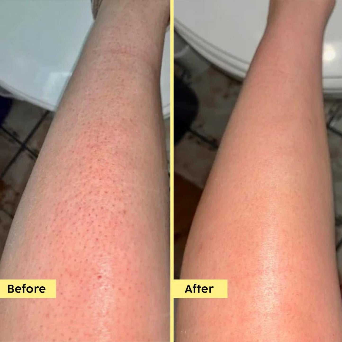 Plix Pineapple 5% Lactic Acid Body Wash Exfoliates Dry, Rough & Strawberry Skin With Deep Cleansing