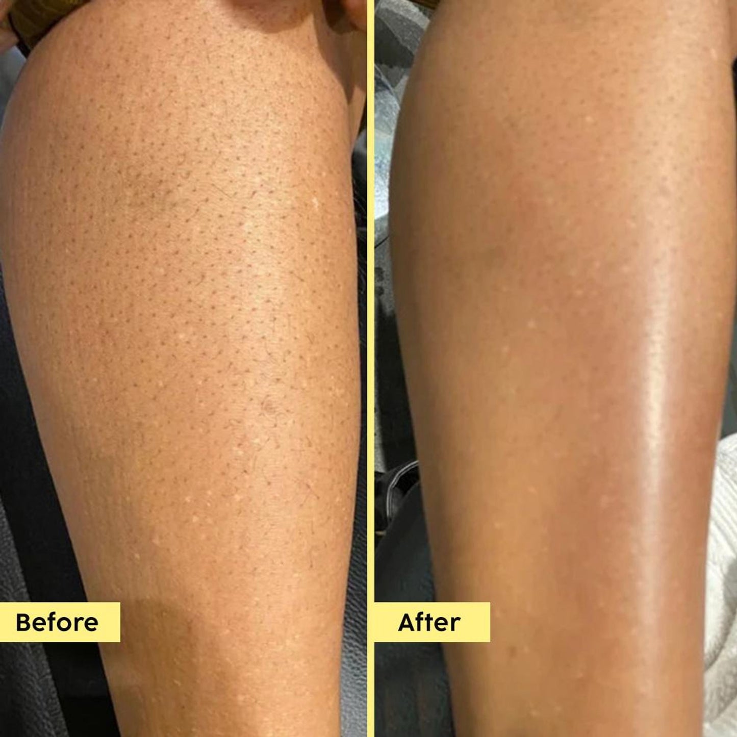 Plix Pineapple 5% Lactic Acid Body Wash Exfoliates Dry, Rough & Strawberry Skin With Deep Cleansing