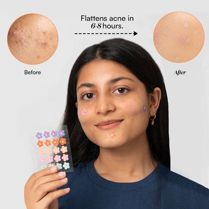 Gush Beauty Dart It Pimple Patches Work in 6-8 Hrs For Acne, Zits And Blemishes - Holographic Butterfly
