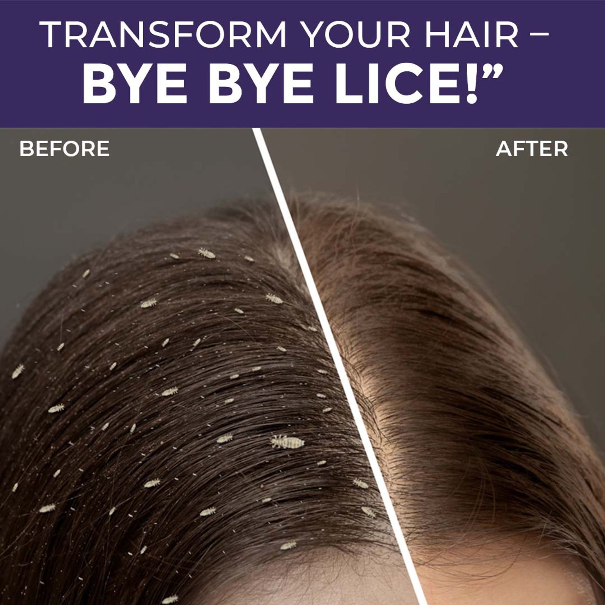 Sanfe Anti Lice & Dandruff Shampoo