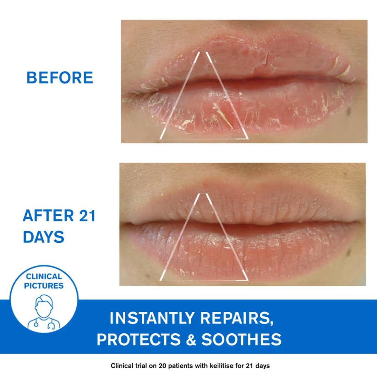 Uriage Bariederm-Cica Protecting Dermat Recommended Lip Balm Repairs Soothes Chapped Damaged Lips