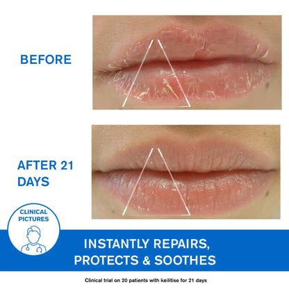 Uriage Bariederm-Cica Protecting Dermat Recommended Lip Balm Repairs Soothes Chapped Damaged Lips
