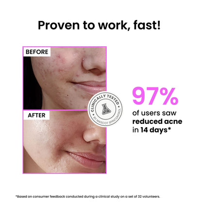 Foxtale 12% Niacinamide Brightening Face Serum, Fades Dark Spots & Acne marks, For Oil Control