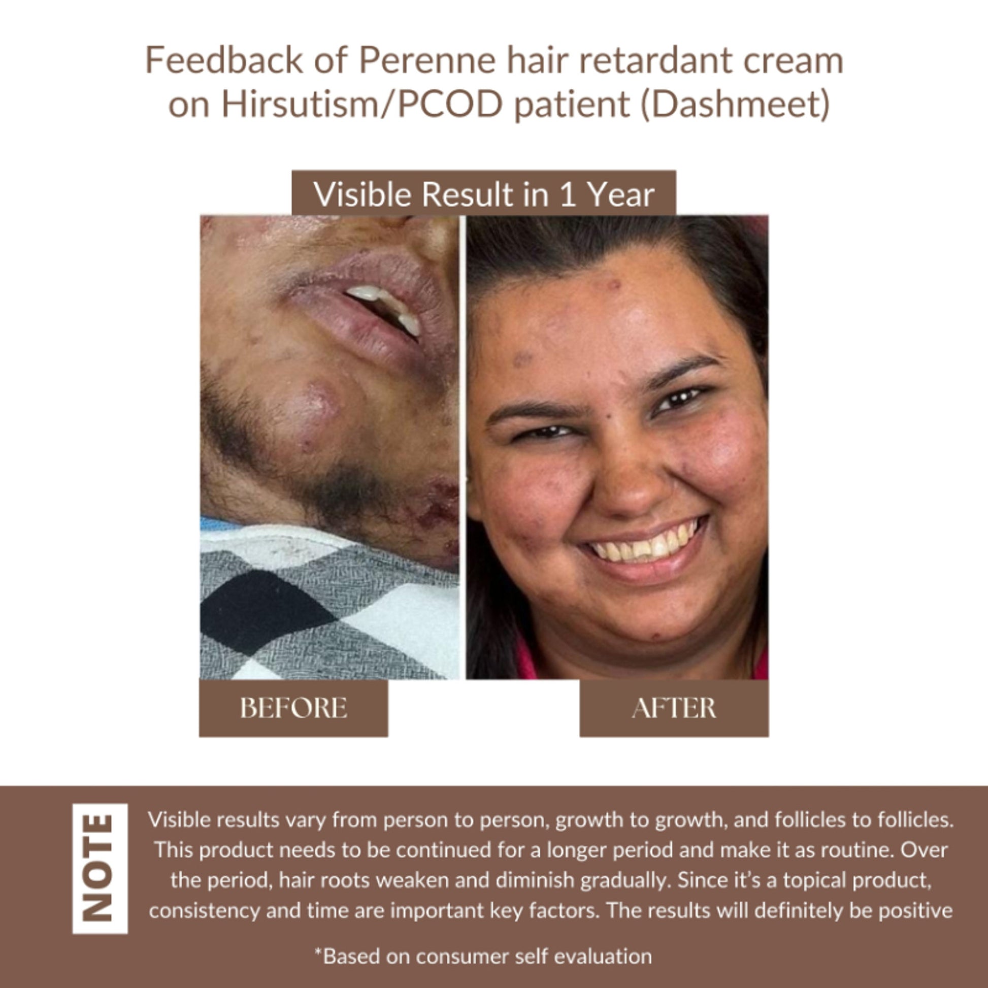 Perenne Hair Retardant Cream for Reducing Facial And Body Hair