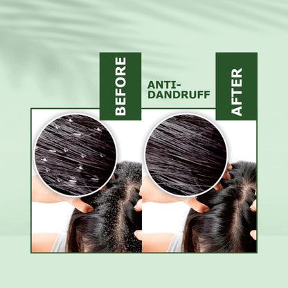 Nuerma Science Anti-Dandruff Oil | Rejuvenate Your Scalp, Rediscover Confidence