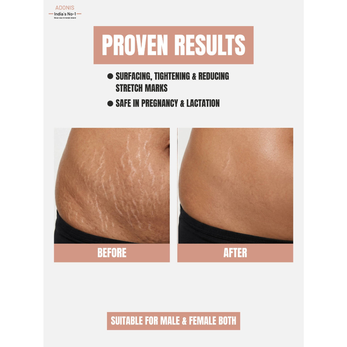 Adonis Stretch Marks Cream with Shea Butter & Vitamin E for Hydrated Smooth Skin