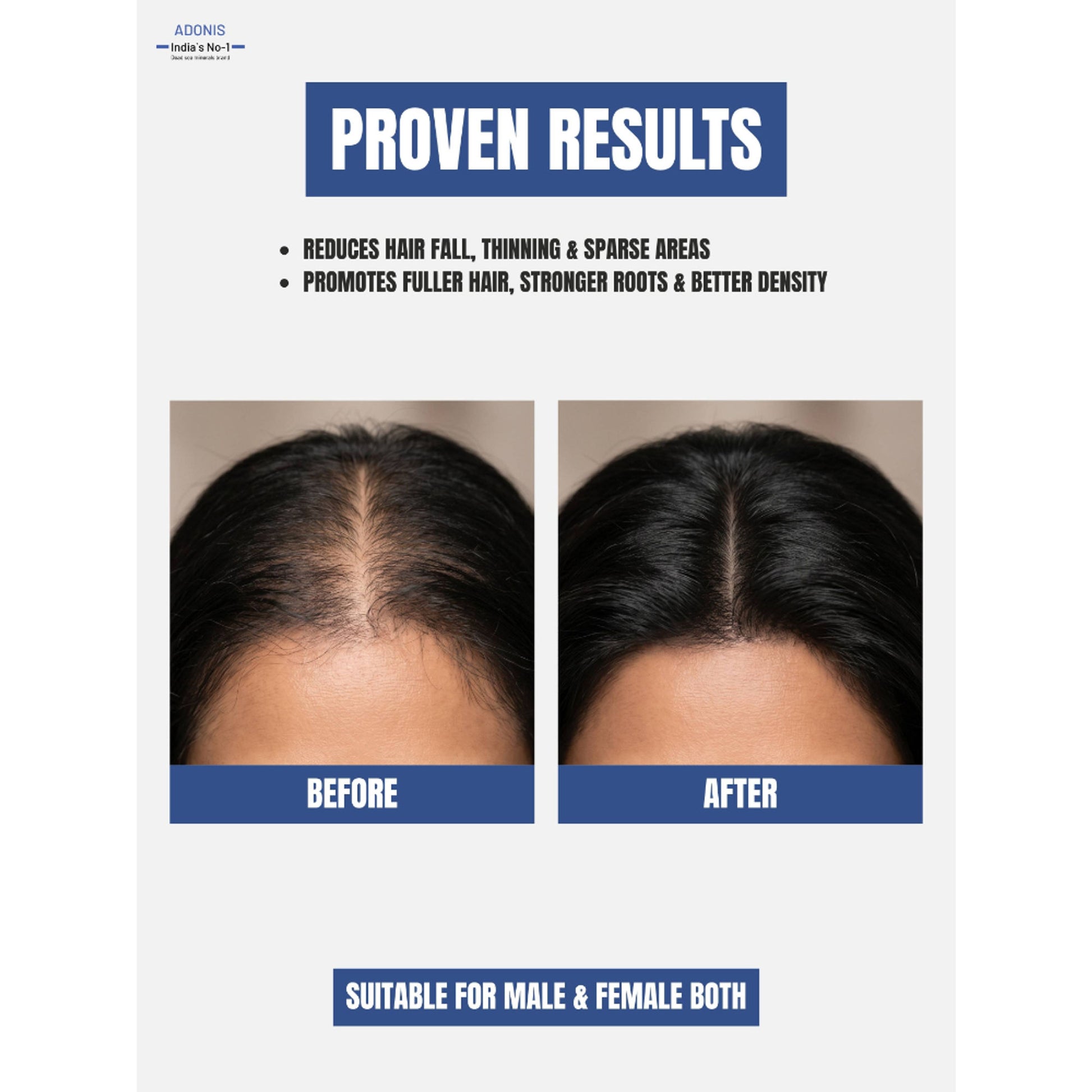 Adonis Biodens Pro Lotion With Minoxidil & Procapil For Hair Growth Control