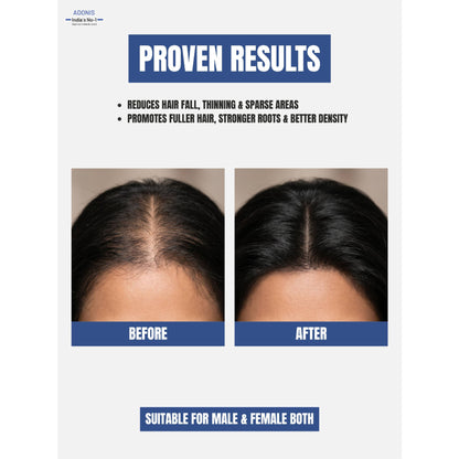 Adonis Biodens Pro Lotion With Minoxidil & Procapil For Hair Growth Control