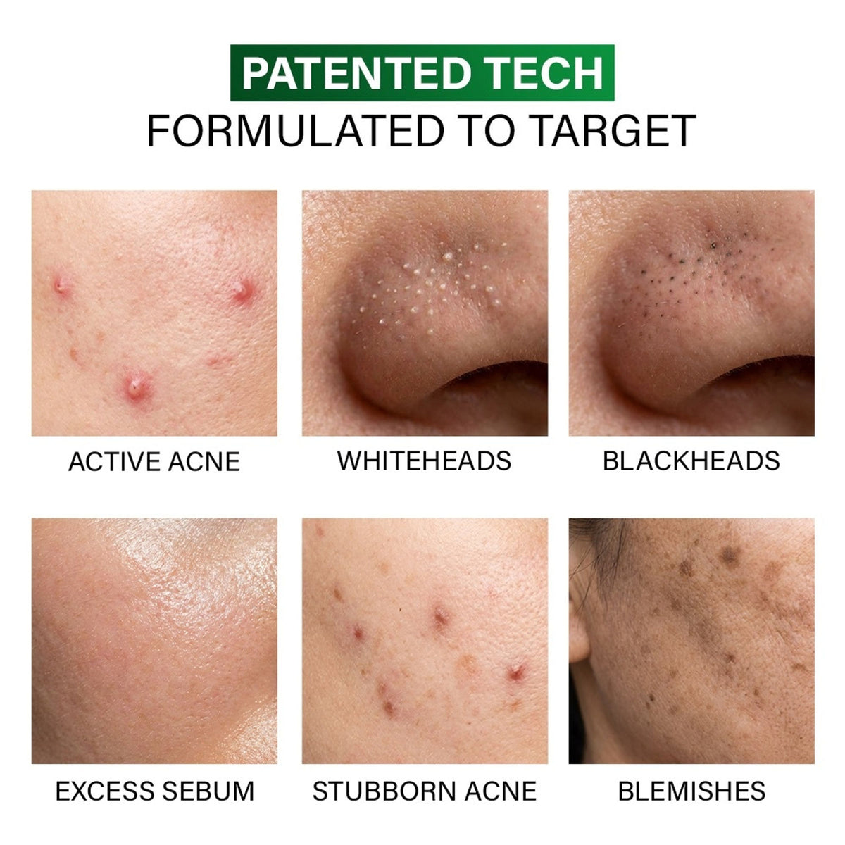 Novology Acne Spot Corrector, For Pimples, Whiteheads, Blackheads, For Sensitive Skin, Dermat Tested