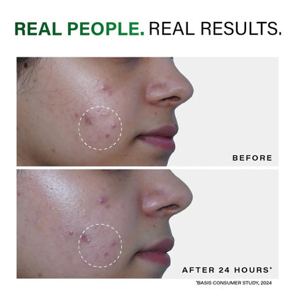 Novology Acne Spot Corrector, For Pimples, Whiteheads, Blackheads, For Sensitive Skin, Dermat Tested